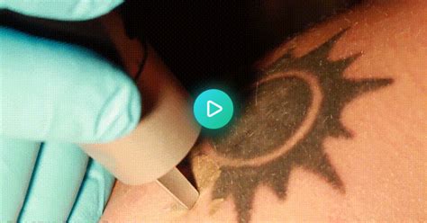 Laser Tattoo Removal  On Imgur