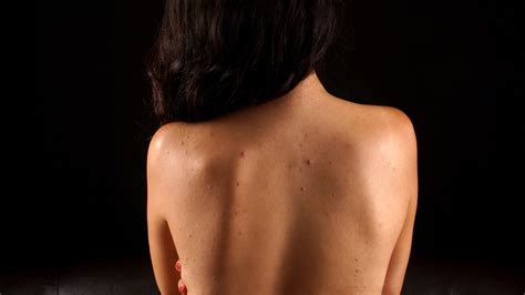 How To Banish Back And Chest Acne Treatments For Body Acne Allure