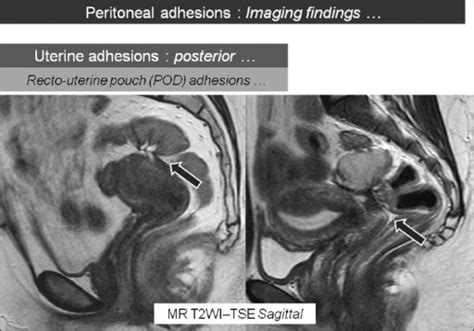 sagittal t2w mr images showing recto uterine pouch pou open i