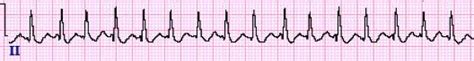 Atrial Fibrillation Ecg Review Criteria And Examples