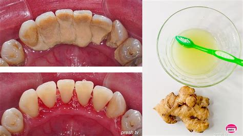 how to remove tartar from teeth at home naturally natural ways to
