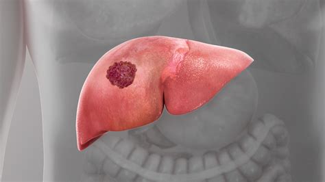 liver cancer symptoms causes and treatment scientific animations