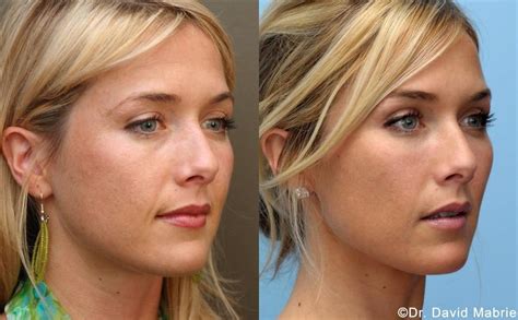 View Cheeks Before And After Photos Of Mabrie Facial Cosmetic Inc