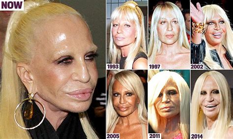 Arriba 61 Imagen Donatella Versace Before And After Plastic Surgery