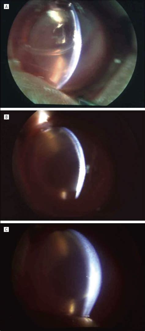 Descemet Stripping Automated Endothelial Keratoplasty Using Cultured
