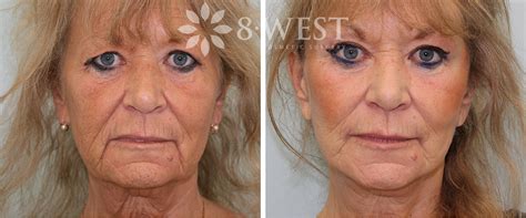 facelift cosmetic plastic surgery
