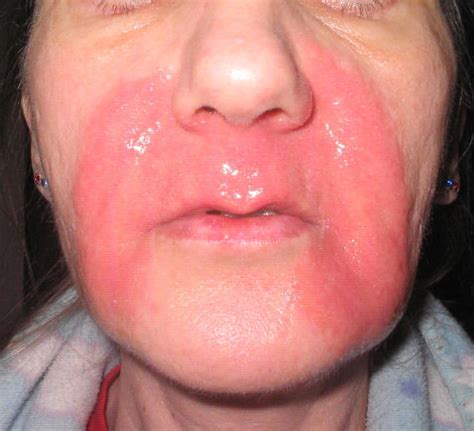 home treatment  chemical burns