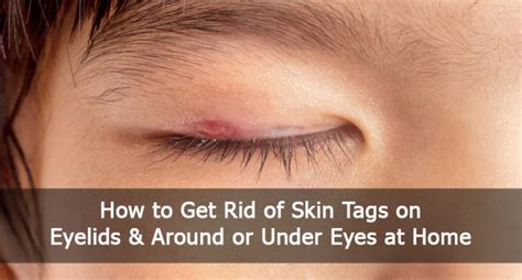 how to get rid of skin tags on eyelids and around or under eyes at home academic association of