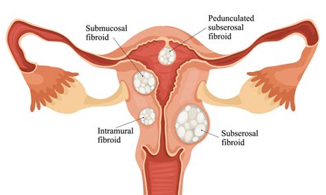 Know The Difference Between Cysts And Fibroids Health Plus