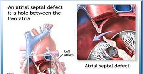 todays event  care   health todays event heart atrial septal defect asd