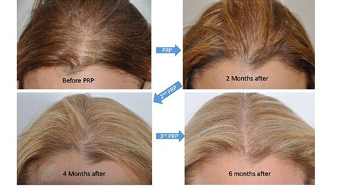 hair loss treatments surgical for women dr david rosenberg