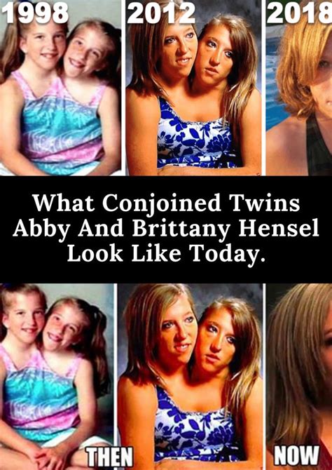 Abby And Brittany Hensel Conjoined Twins Professornose