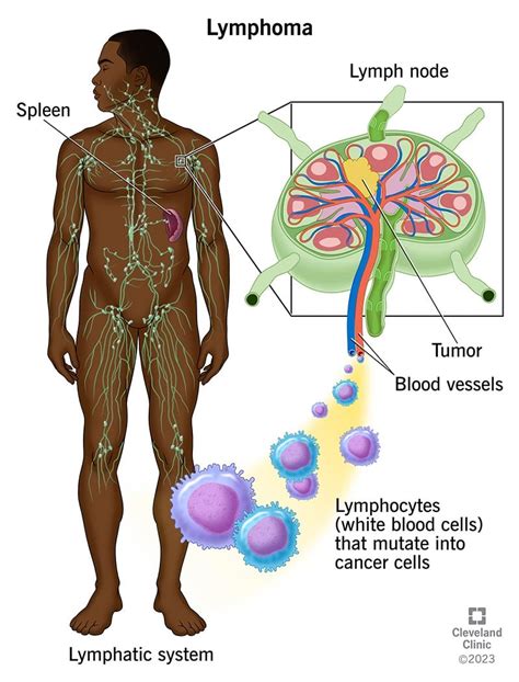 lymphoma symptoms   treatment