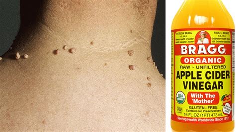 skin tag removal with apple cider vinegar use this paste to remove
