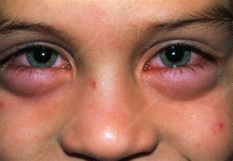 child  swollen eyes   allergic reaction stock image