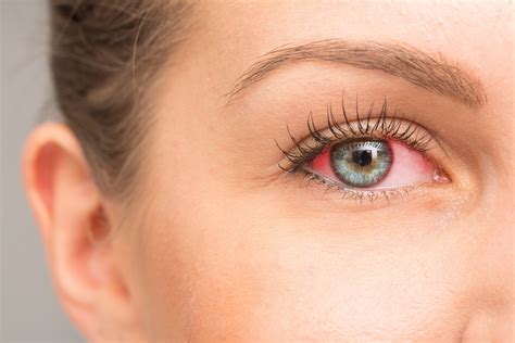 red eye  irritation   sclera  pulse
