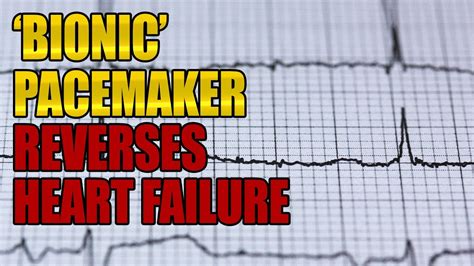 revolutionary bionic pacemaker capable  reversing heart failure  set  human trials