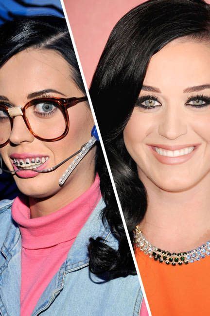 famous faces with braces celebrities with braces braces off celebrity smiles