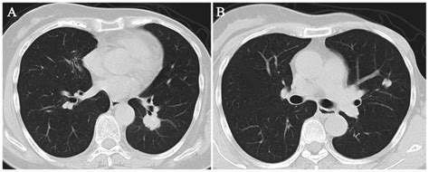 Lung Metastases Breast Cancer