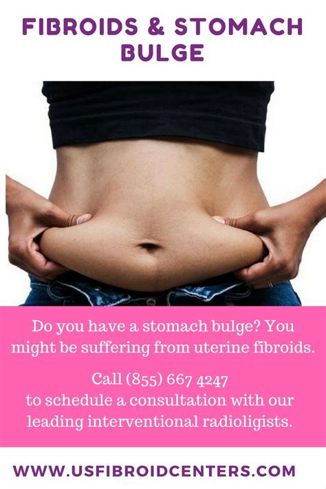 Stomach Bulging Learn About Fibroids Today Usa Fibroid Fibroids
