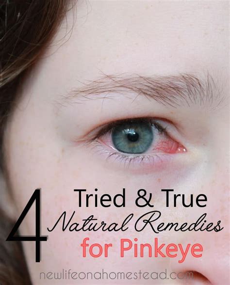 true natural remedies  pinkeye  life