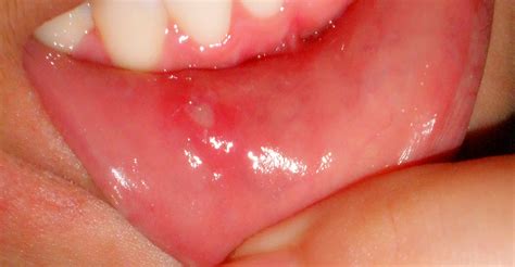 Aphthous Ulcers Canker Sores Bondistry
