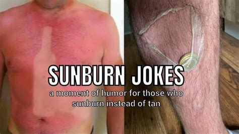 40 Funny Sunburn Jokes For That Shedding Skin In 2022