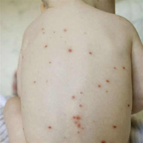 anti vaccine community behind north carolina chickenpox outbreak bbc news