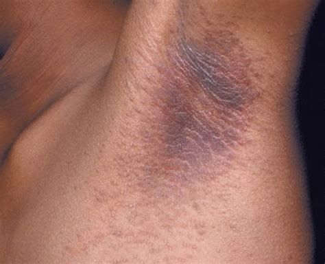 acanthosis nigricans causes symptoms treatment