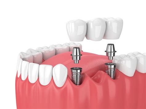 dental implants noticeable north houston periodontics dental