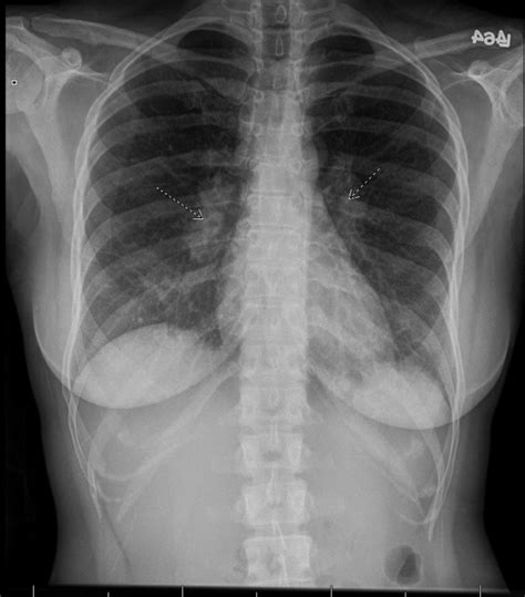 Chest X Ray Showing Bilateral Hilar Lymphadenopathy In A Patient With