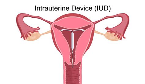 Intrauterine Device Iud Types Methods And Effectiveness
