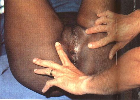 clitless female circumcison and infibulation motherless