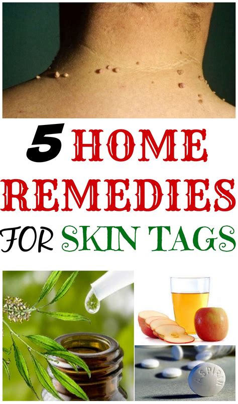 5 home remedies for skin tags daily beauty tricks dicas saúde