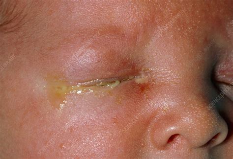 newborn baby  sticky eye  conjuctivitis stock image