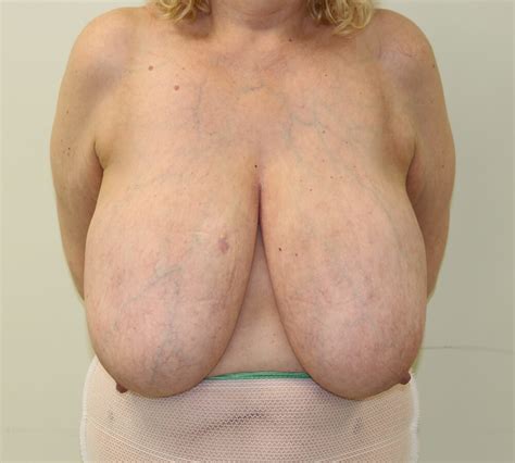 Breast Reduction My Avatar 2 Pics Xhamster