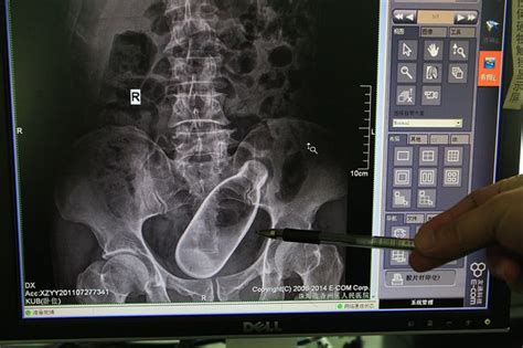 Shocking X Ray Shows Bottle Stuck Inside Old Man’s Rectal