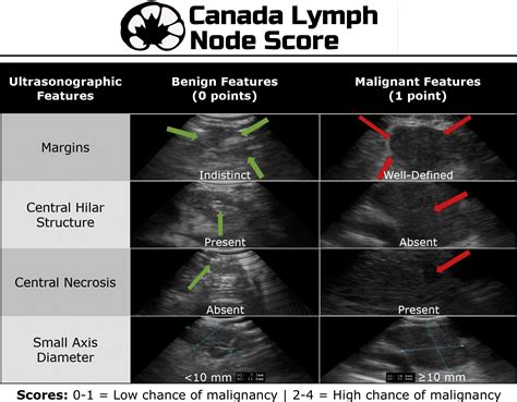 The Canada Lymph Node Score For Prediction Of Malignancy In Mediastinal