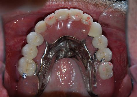 partial dentures types