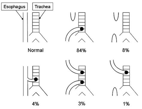 Esophageal Atresia Tracheoesophageal Fistula Medlineplus Genetics