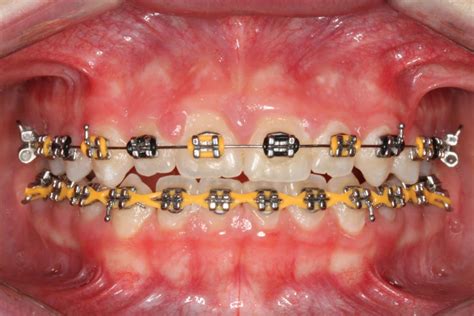 colorful braces are becoming a fashion statement