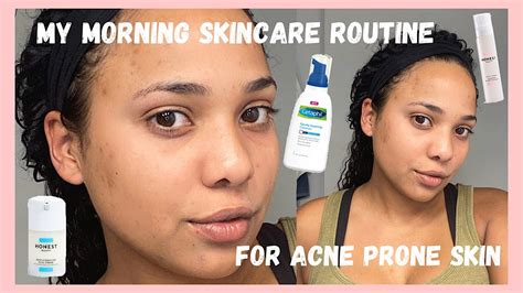 My Morning Skincare Routine For Acne Prone Skin