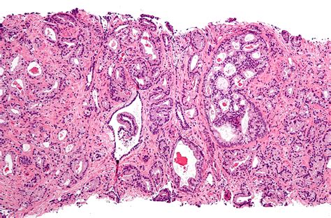 fileprostate cancer  gleason pattern   magjpg wikipedia