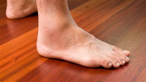 Top Effective 16 Ways To Get Rid Of Swollen Legs Ankles
