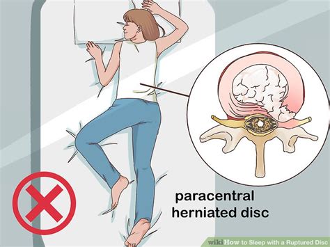 3 ways to sleep with a ruptured disc wikihow