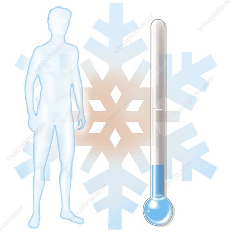 hypothermia stock image  science photo library