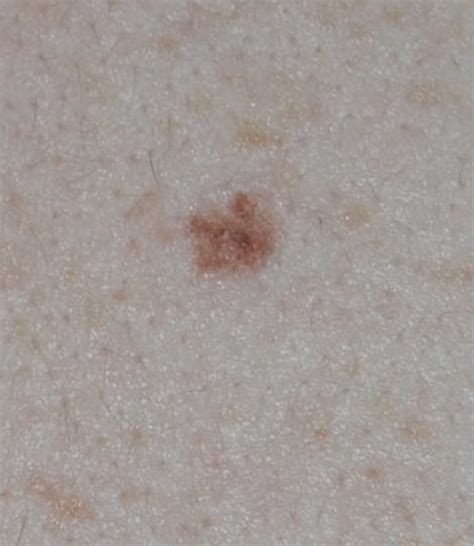 skin cancer forum does this look like melanoma