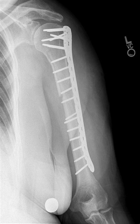 complex fracture humerus