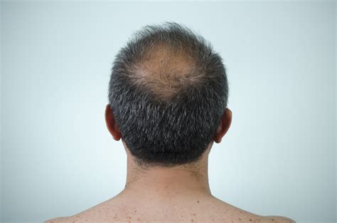the back view of a man s head who is balding dermatology associates