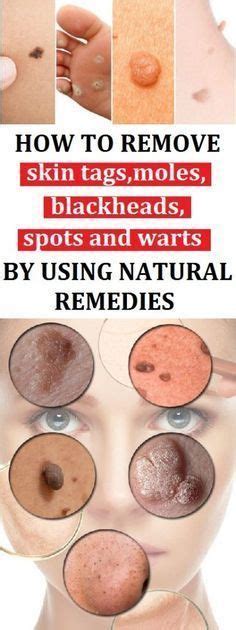 how to remove skin tags moles blackheads spots and